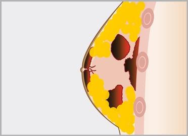 mastitis_372x270.jpg