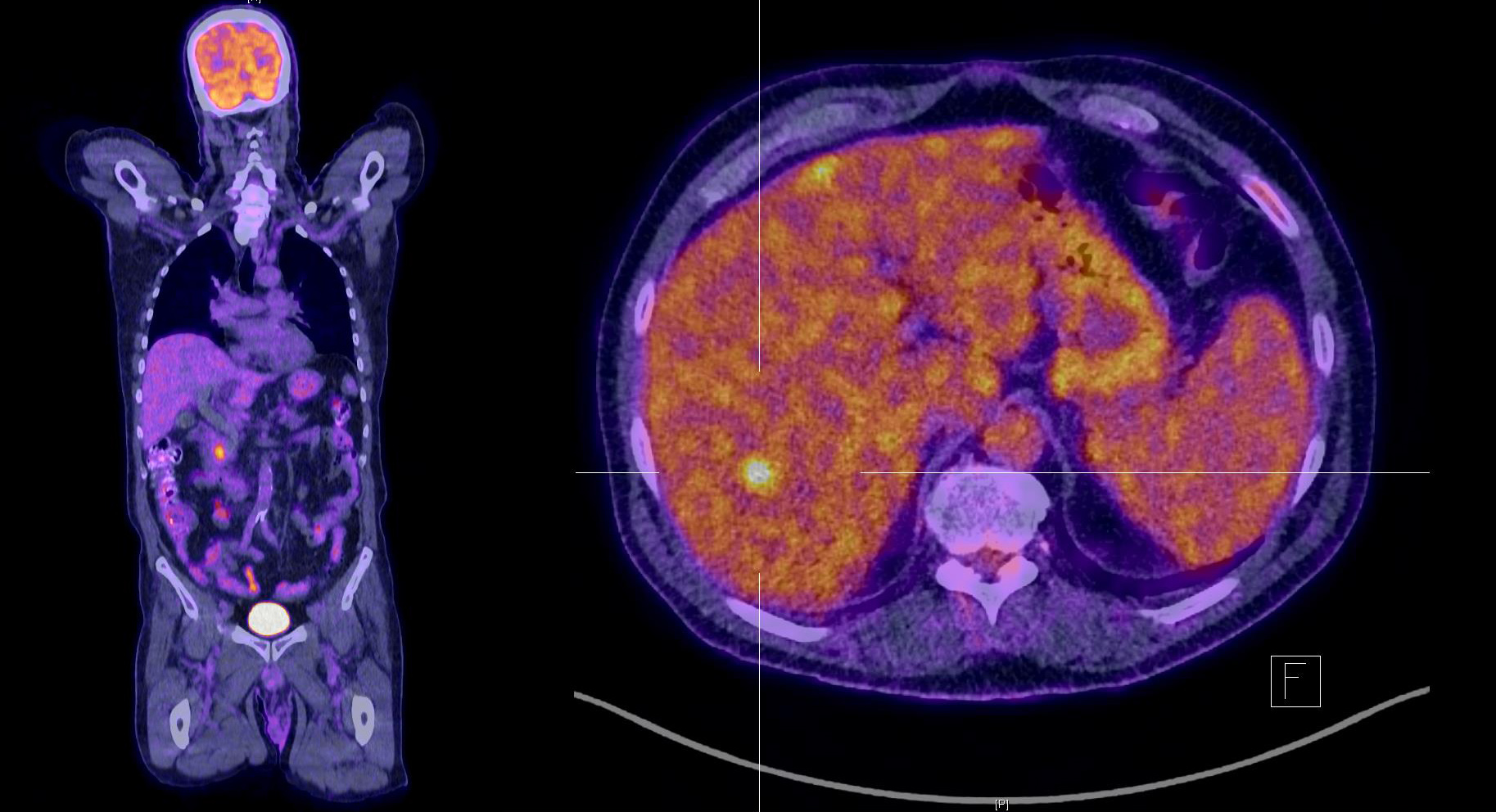 pankreas_petct.jpg pankreas_petct.jpg