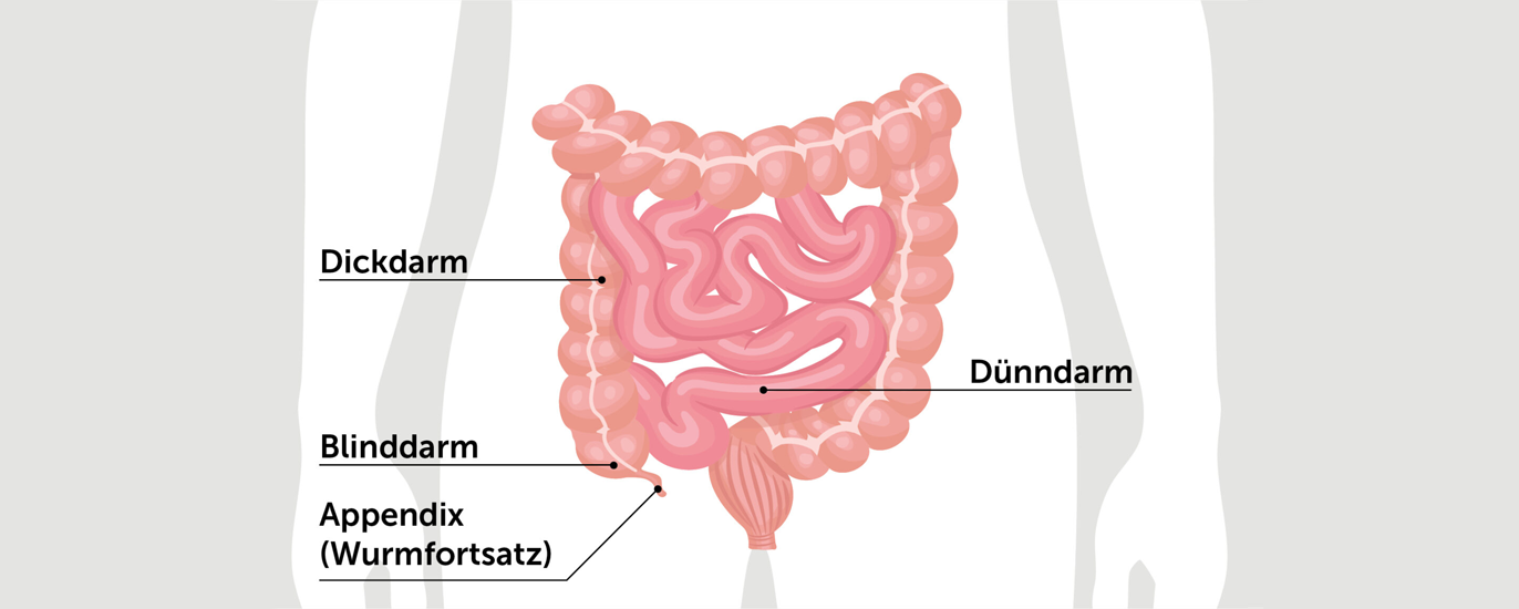 Appendizitis