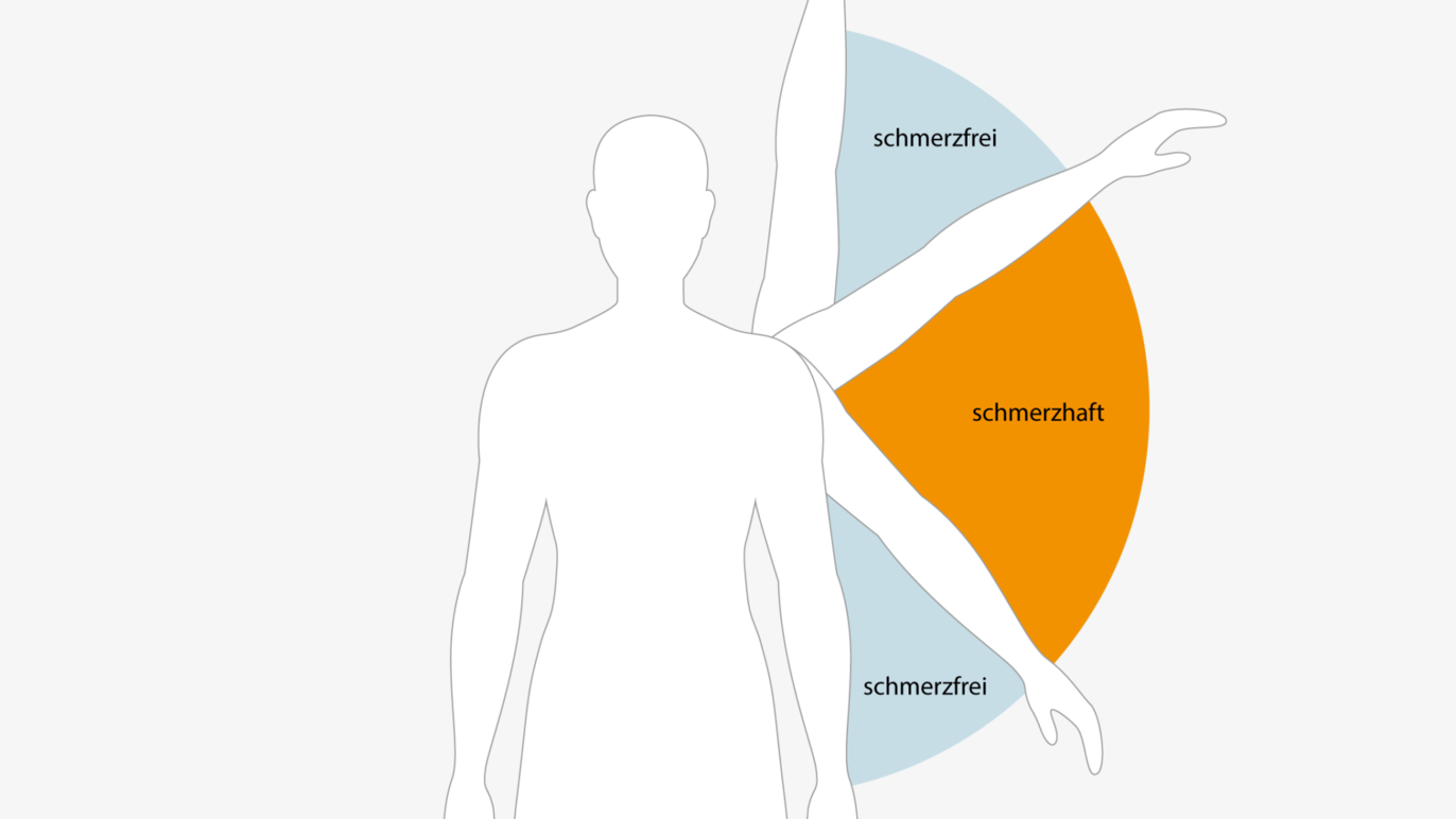 ksb-blog_schulter_impingement_content-2048x1152-1.png