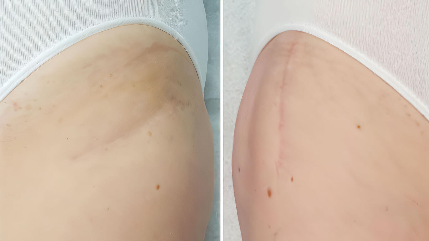 Bikininarbe im Vergleich