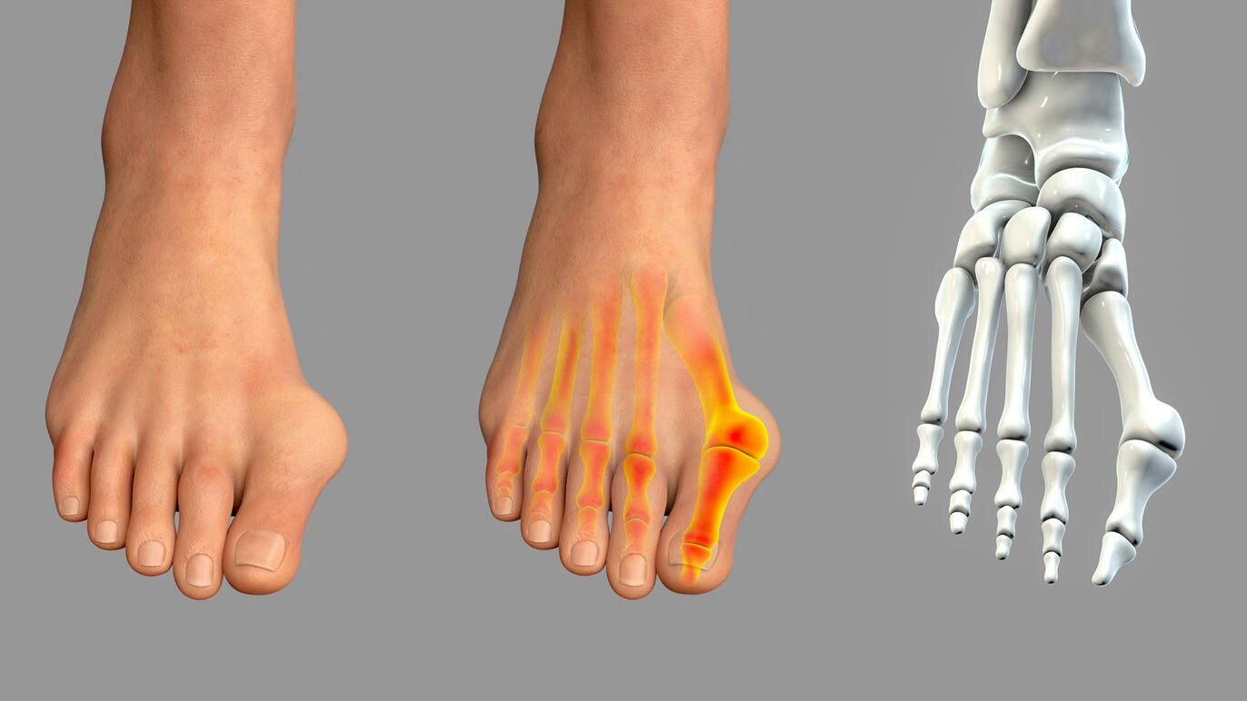 Hallux Valgus