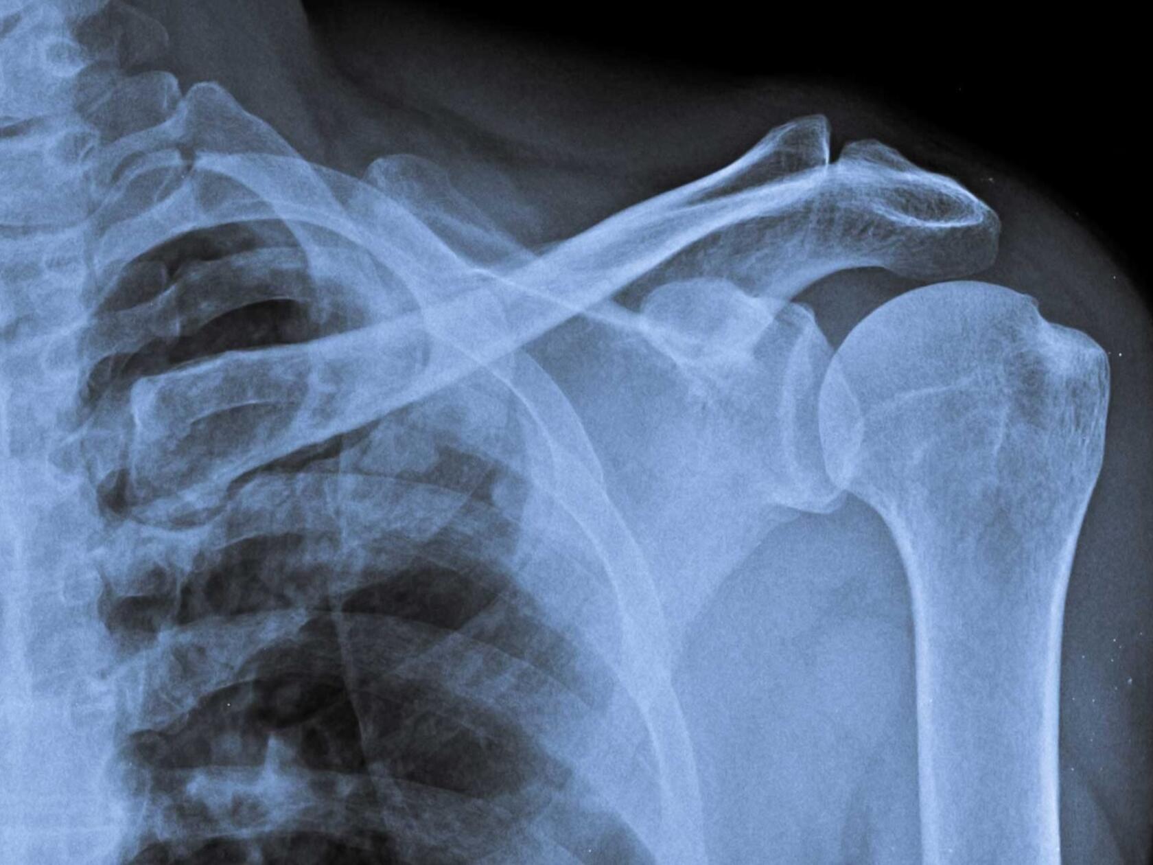 ksb-blog_frozen_shoulder_content02.jpg