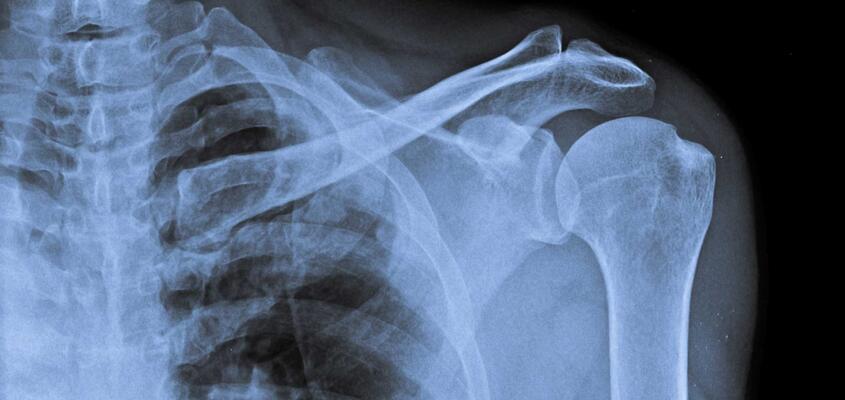 ksb-blog_frozen_shoulder_content02.jpg