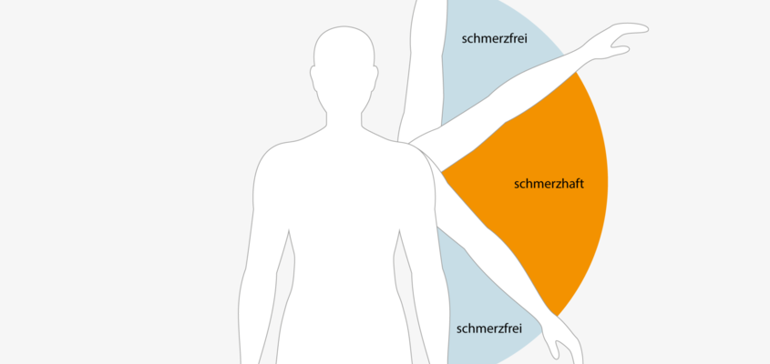 ksb-blog_schulter_impingement_content-2048x1152-1.png