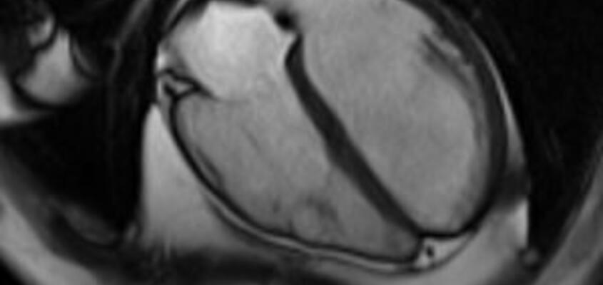 ksb-herz-stress-mri-content1-300x300.jpg