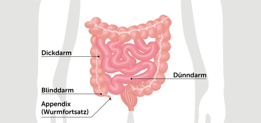 Appendizitis