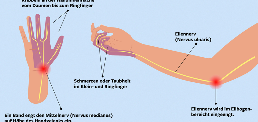 Kribbeln Hand