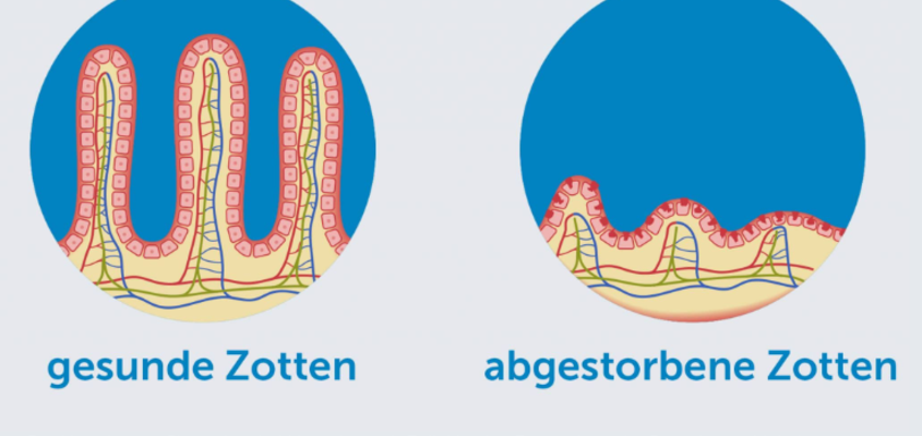 Darm bei Zöliakie