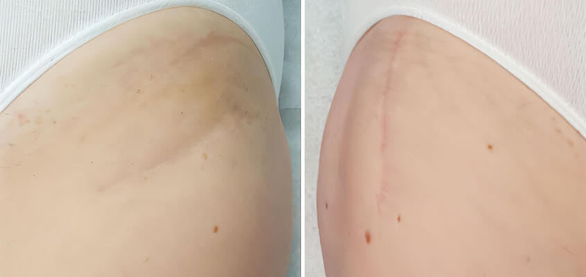 Bikininarbe im Vergleich