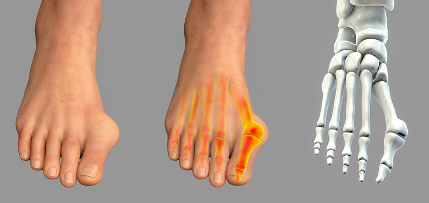 Hallux Valgus