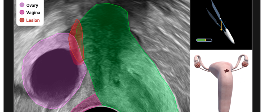 Grafik Endometriose Erkennung